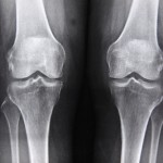 BCM stem cell treatments seen as best option for knee osteoarthritis