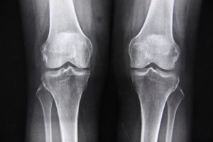 BCM stem cell treatments seen as best option for knee osteoarthritis