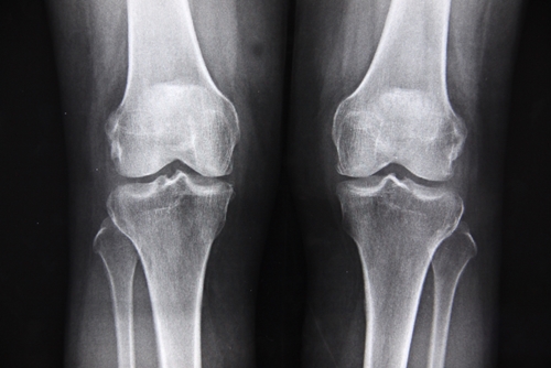 BCM stem cell treatments seen as best option for knee osteoarthritis